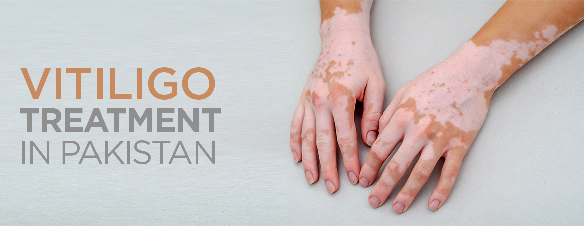 Best Vitiligo Treatment in Pakistan